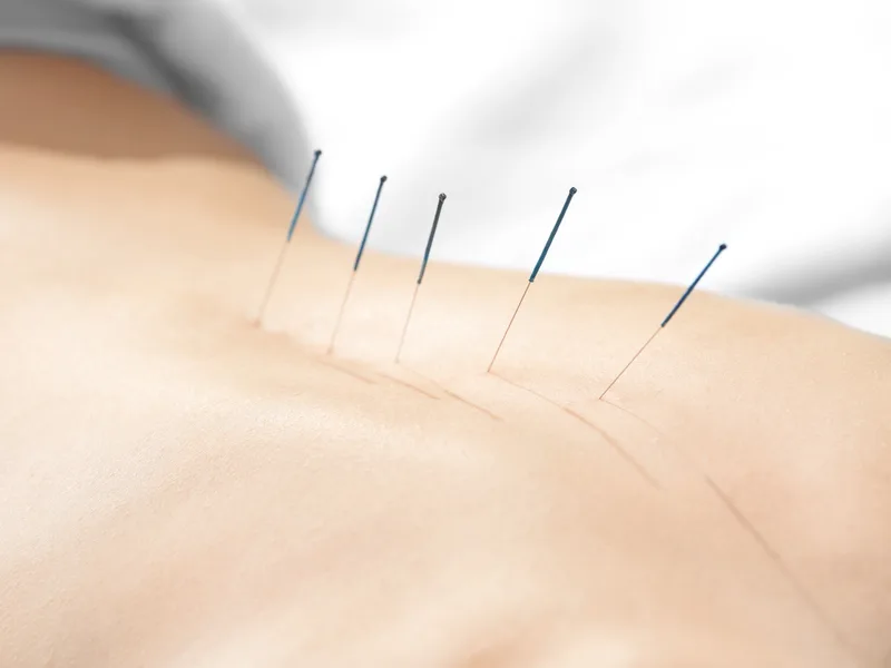 Acupuncture at Heights Chiropractic Center in Houston