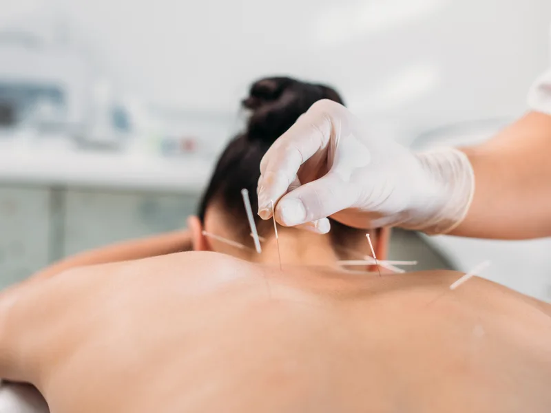Dry Needling at Heights Chiropractic Center in Houston
